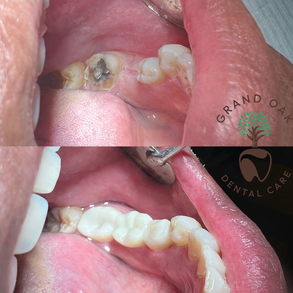 Three-Unit Zirconia Bridge Restoration